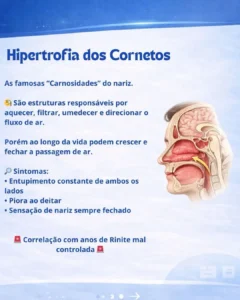 Dr. Vitor Arrais, médico otorrinolaringologista em Recife especialista em problemas nasais, respiração e distúrbios do sono para adultos e crianças.